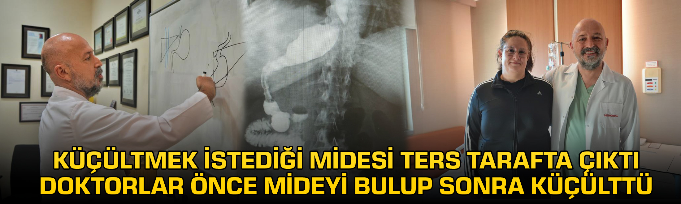 Küçültmek istediği midesi ters tarafta çıktı, doktorlar önce mideyi bulup sonra küçülttü